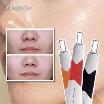 探索皮秒 discovery-pico 新願美學診所（郭毅昕醫師｜台北醫美推薦｜台北海芙音波媚必提｜海芙電波｜海菲秀｜探索皮秒｜喬雅登｜熊貓針推薦）