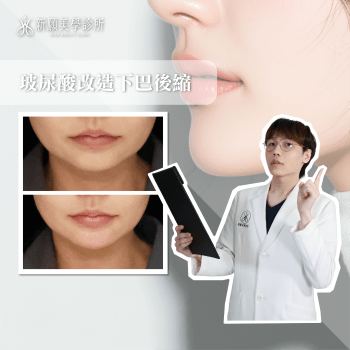 下巴後縮怎麼辦？玻尿酸填充改善臉型比例，打造立體輪廓線