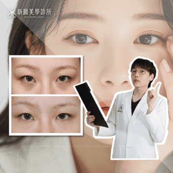 淚溝與玻尿酸填補完整解析：從成因到改善方式