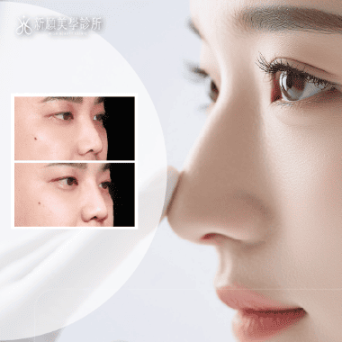 埋線鼻雕全攻略：打造自然挺鼻的非手術選擇