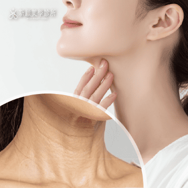 頸部紋路很顯老？玻尿酸填充，重拾緊緻平滑頸部肌膚