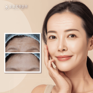 肉毒除皺完整解析：原理、效果、價格、副作用一次看懂