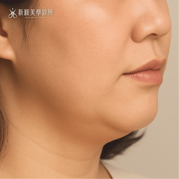 輪廓線模糊怎麼辦？找出成因、對症改善，重現俐落下顎線