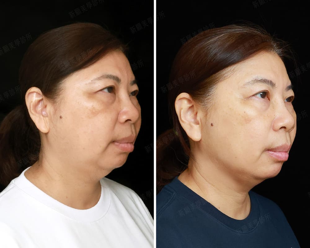 音波 新願美學診所（郭毅昕醫師｜台北醫美推薦｜台北海芙音波媚必提｜海芙電波｜海菲秀｜探索皮秒｜喬雅登｜熊貓針推薦）