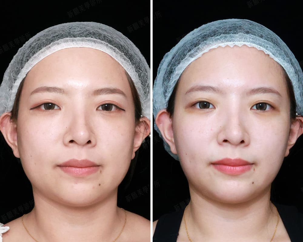 音波 新願美學診所（郭毅昕醫師｜台北醫美推薦｜台北海芙音波媚必提｜海芙電波｜海菲秀｜探索皮秒｜喬雅登｜熊貓針推薦）