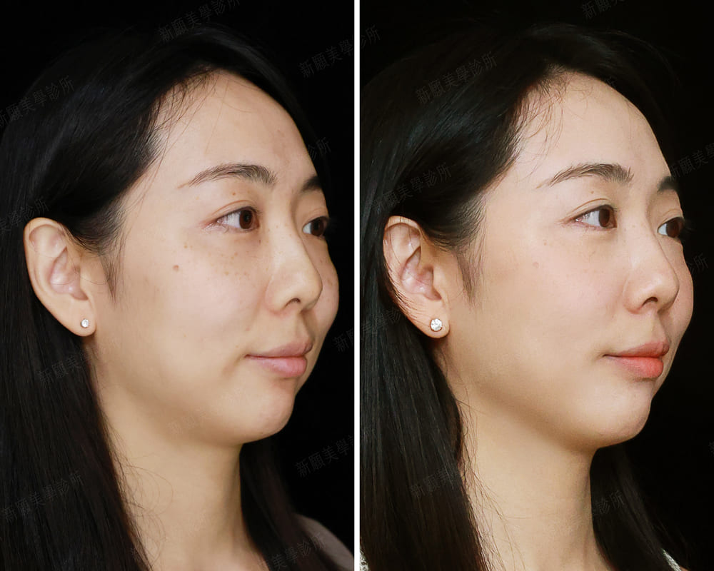 音波 新願美學診所（郭毅昕醫師｜台北醫美推薦｜台北海芙音波媚必提｜海芙電波｜海菲秀｜探索皮秒｜喬雅登｜熊貓針推薦）