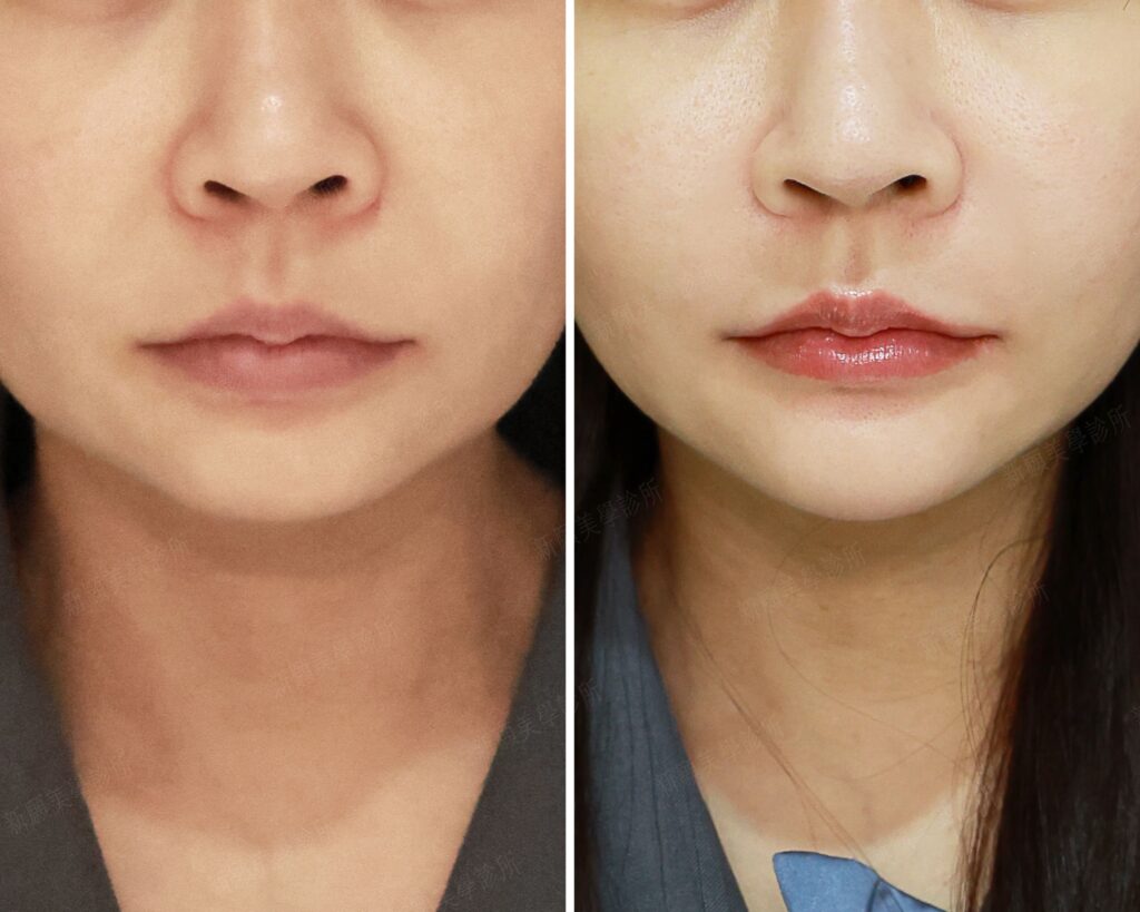 下巴(新願美學診所（郭毅昕醫師｜台北醫美推薦｜台北海芙音波媚必提｜海芙電波｜海菲秀｜探索皮秒｜喬雅登｜熊貓針推薦）