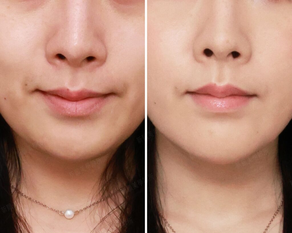 下巴(新願美學診所（郭毅昕醫師｜台北醫美推薦｜台北海芙音波媚必提｜海芙電波｜海菲秀｜探索皮秒｜喬雅登｜熊貓針推薦）