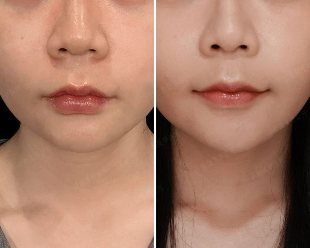 下巴(新願美學診所（郭毅昕醫師｜台北醫美推薦｜台北海芙音波媚必提｜海芙電波｜海菲秀｜探索皮秒｜喬雅登｜熊貓針推薦）
