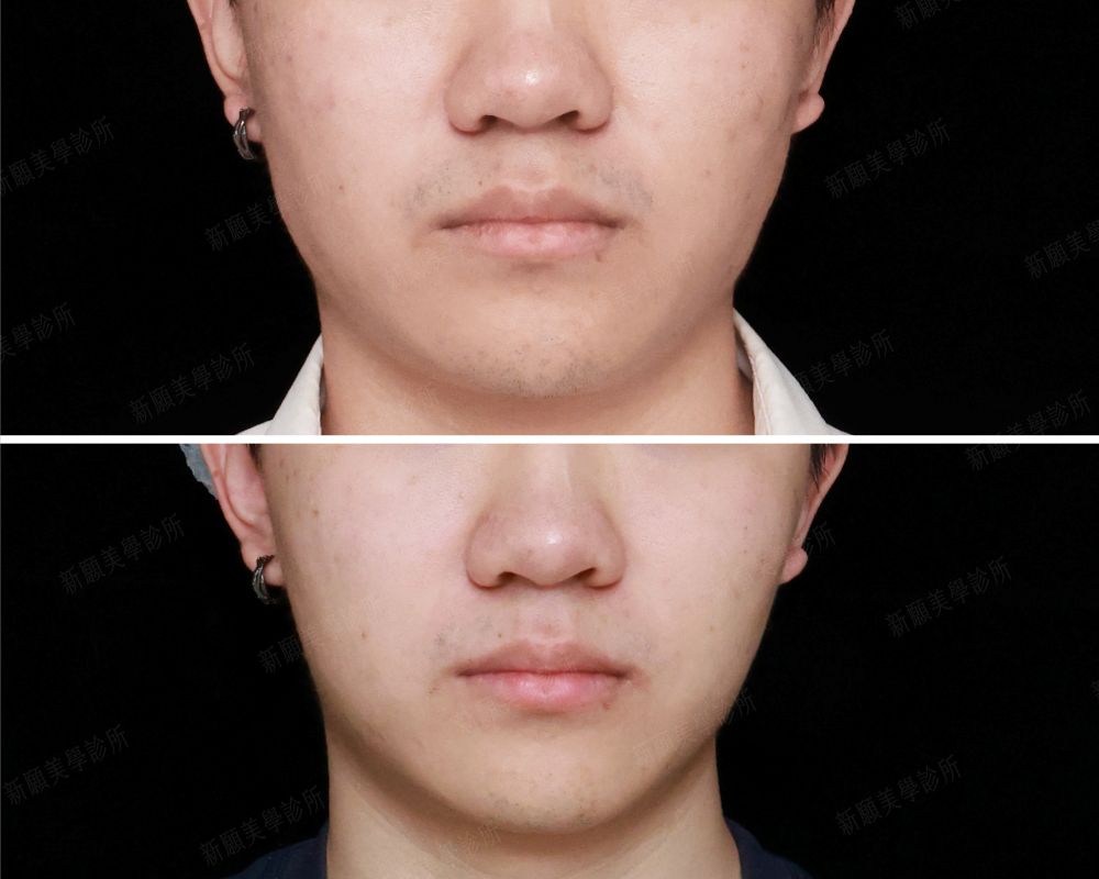 肉毒除皺咀嚼肌 新願美學診所（郭毅昕醫師｜台北醫美推薦｜台北海芙音波媚必提｜海芙電波｜海菲秀｜探索皮秒｜喬雅登｜熊貓針推薦）