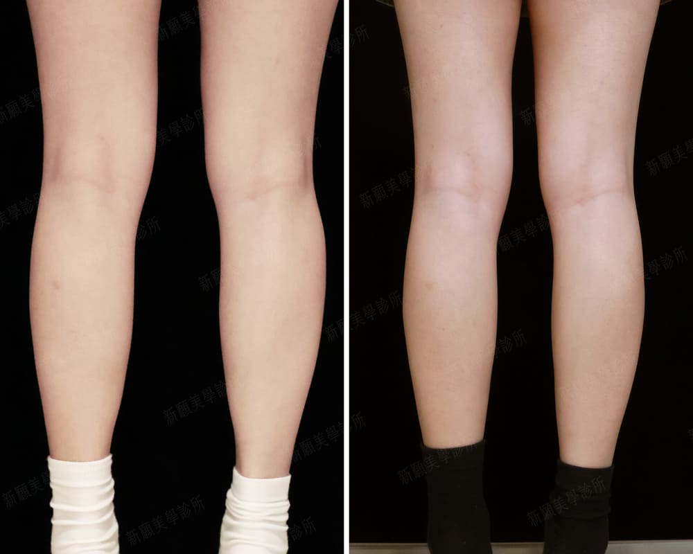 小腿肌 新願美學診所（郭毅昕醫師｜台北醫美推薦｜台北海芙音波媚必提｜海芙電波｜海菲秀｜探索皮秒｜喬雅登｜熊貓針推薦）