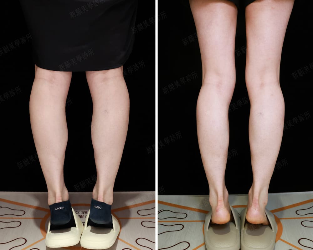 小腿肌 新願美學診所（郭毅昕醫師｜台北醫美推薦｜台北海芙音波媚必提｜海芙電波｜海菲秀｜探索皮秒｜喬雅登｜熊貓針推薦）