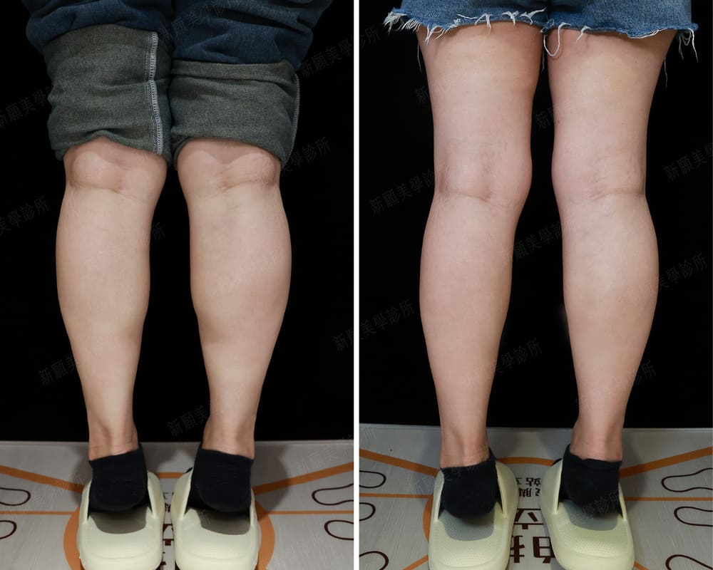 小腿肌 新願美學診所（郭毅昕醫師｜台北醫美推薦｜台北海芙音波媚必提｜海芙電波｜海菲秀｜探索皮秒｜喬雅登｜熊貓針推薦）