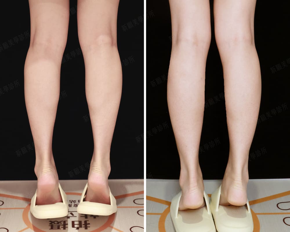 小腿肌 新願美學診所（郭毅昕醫師｜台北醫美推薦｜台北海芙音波媚必提｜海芙電波｜海菲秀｜探索皮秒｜喬雅登｜熊貓針推薦）