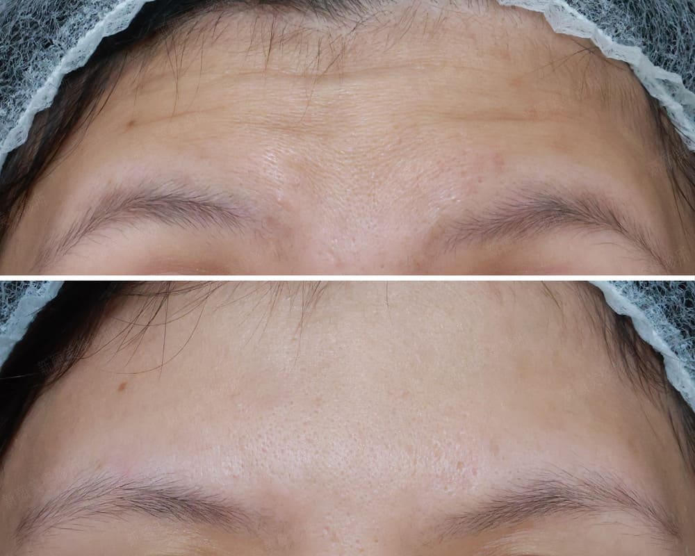 肉毒除皺抬頭紋 新願美學診所（郭毅昕醫師｜台北醫美推薦｜台北海芙音波媚必提｜海芙電波｜海菲秀｜探索皮秒｜喬雅登｜熊貓針推薦）