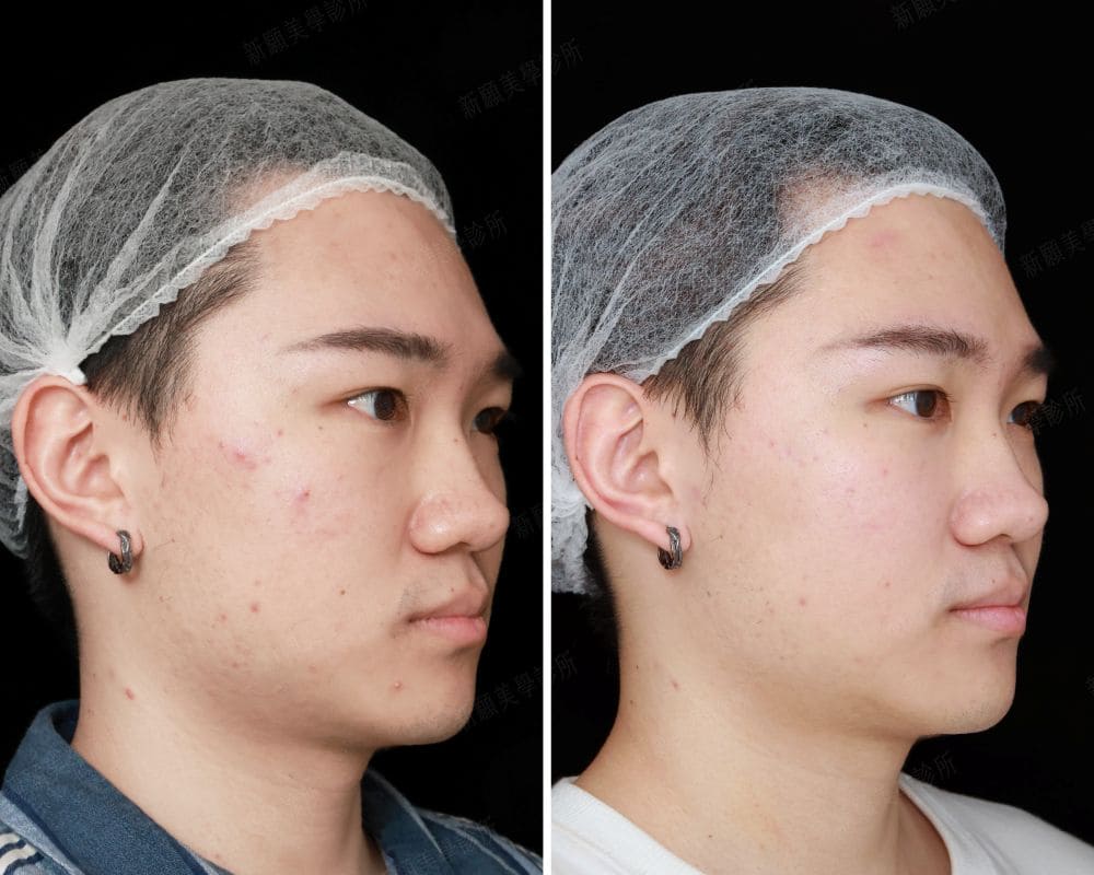 水光針 新願美學診所（郭毅昕醫師｜台北醫美推薦｜台北海芙音波媚必提｜海芙電波｜海菲秀｜探索皮秒｜喬雅登｜熊貓針推薦）