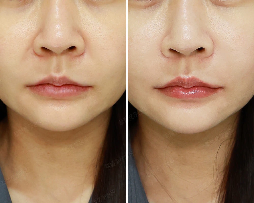 法令紋 新願美學診所（郭毅昕醫師｜台北醫美推薦｜台北海芙音波媚必提｜海芙電波｜海菲秀｜探索皮秒｜喬雅登｜熊貓針推薦）