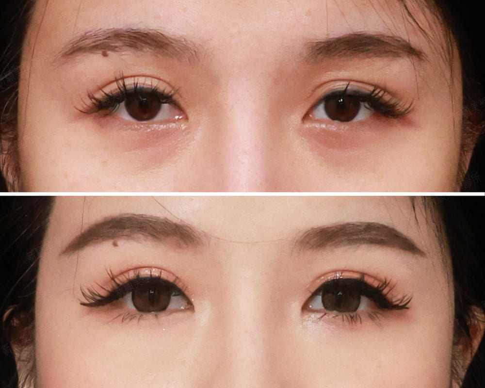 淚溝 新願美學診所（郭毅昕醫師｜台北醫美推薦｜台北海芙音波媚必提｜海芙電波｜海菲秀｜探索皮秒｜喬雅登｜熊貓針推薦）