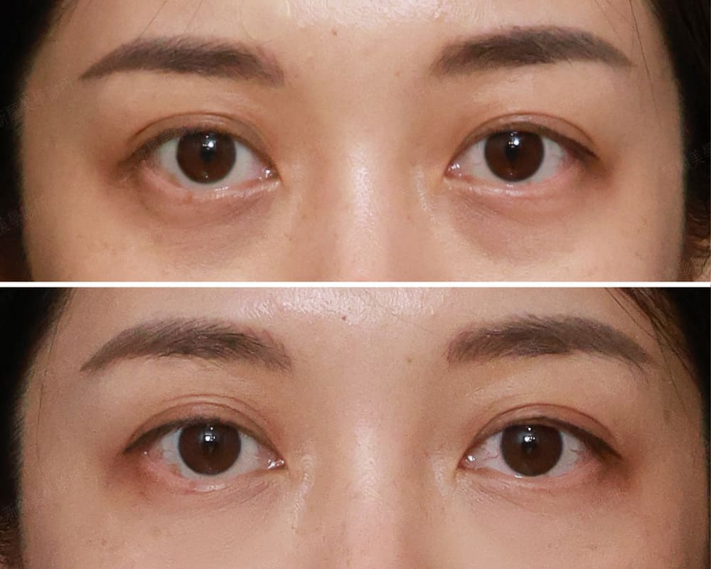 淚溝 新願美學診所（郭毅昕醫師｜台北醫美推薦｜台北海芙音波媚必提｜海芙電波｜海菲秀｜探索皮秒｜喬雅登｜熊貓針推薦）