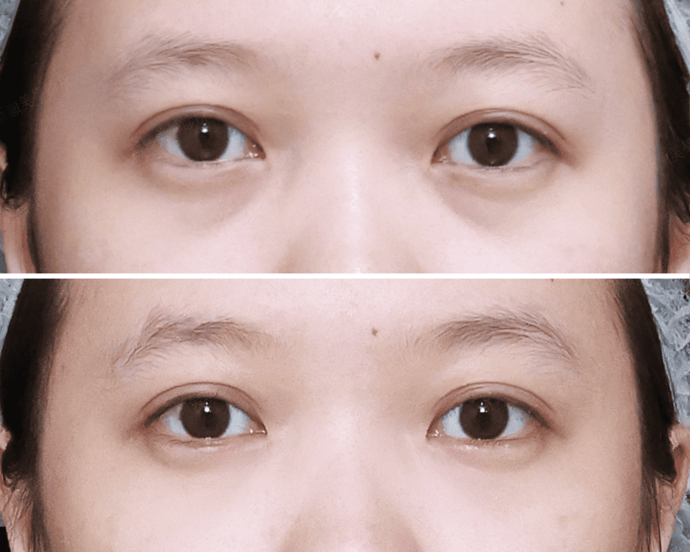 淚溝 新願美學診所（郭毅昕醫師｜台北醫美推薦｜台北海芙音波媚必提｜海芙電波｜海菲秀｜探索皮秒｜喬雅登｜熊貓針推薦）