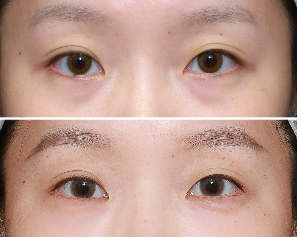 淚溝 新願美學診所（郭毅昕醫師｜台北醫美推薦｜台北海芙音波媚必提｜海芙電波｜海菲秀｜探索皮秒｜喬雅登｜熊貓針推薦）