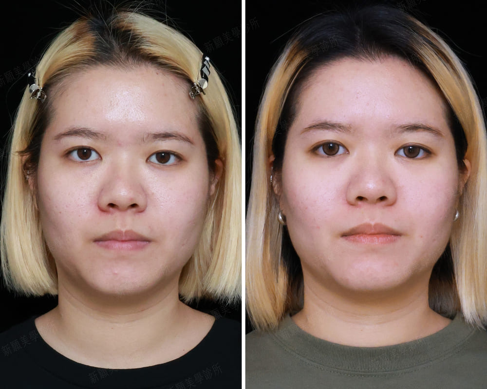 皮秒雷射 新願美學診所（郭毅昕醫師｜台北醫美推薦｜台北海芙音波媚必提｜海芙電波｜海菲秀｜探索皮秒｜喬雅登｜熊貓針推薦）