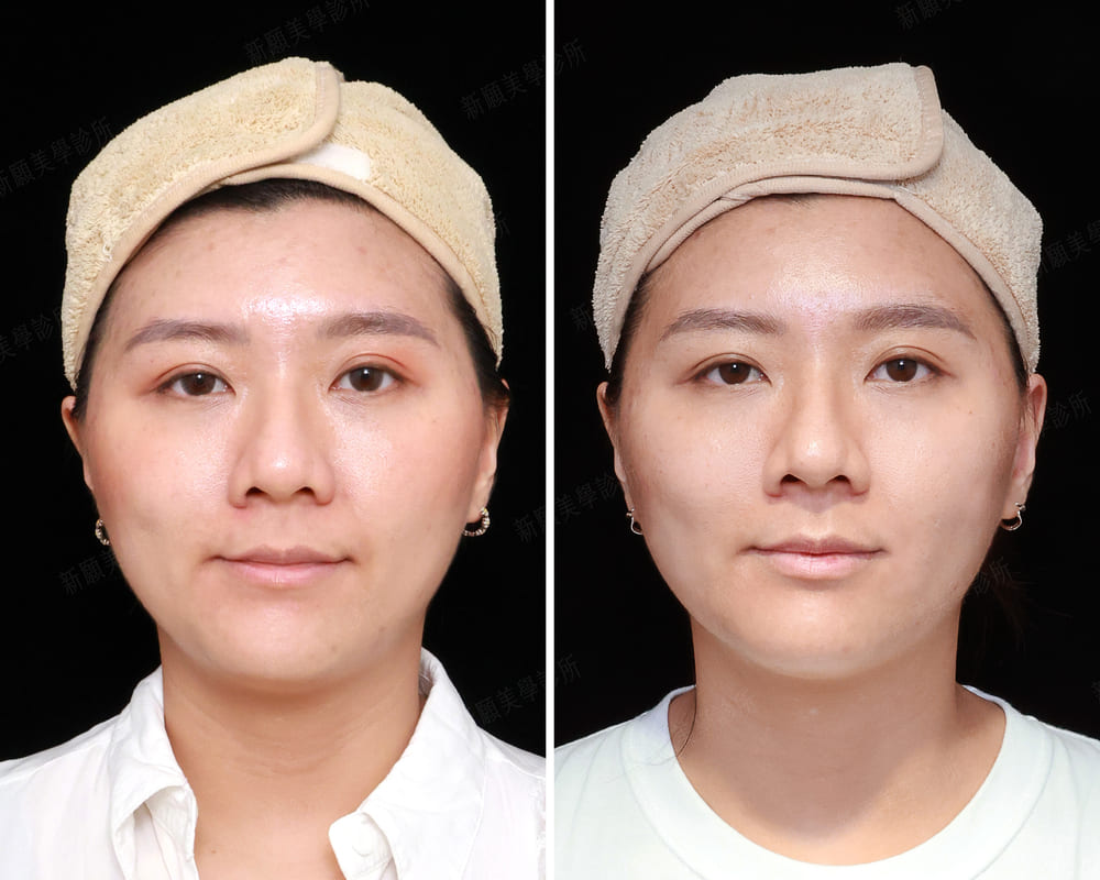 皮秒雷射 新願美學診所（郭毅昕醫師｜台北醫美推薦｜台北海芙音波媚必提｜海芙電波｜海菲秀｜探索皮秒｜喬雅登｜熊貓針推薦）