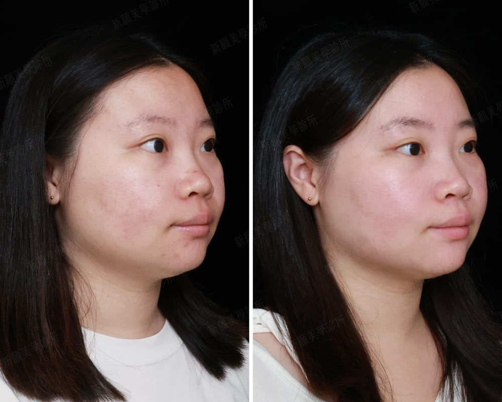 皮秒雷射 新願美學診所（郭毅昕醫師｜台北醫美推薦｜台北海芙音波媚必提｜海芙電波｜海菲秀｜探索皮秒｜喬雅登｜熊貓針推薦）