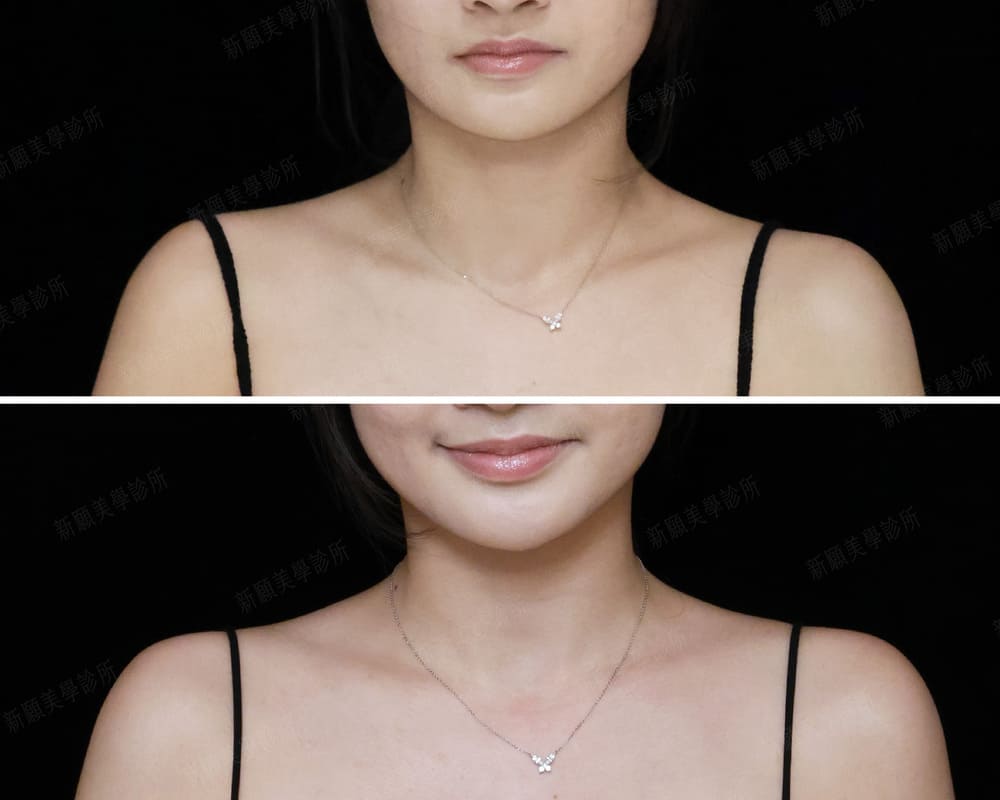 肩膀 新願美學診所（郭毅昕醫師｜台北醫美推薦｜台北海芙音波媚必提｜海芙電波｜海菲秀｜探索皮秒｜喬雅登｜熊貓針推薦）