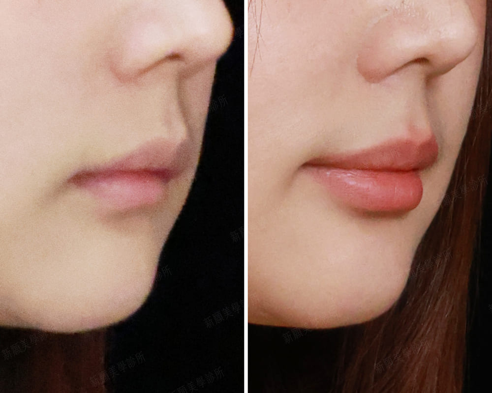 豐唇 新願美學診所（郭毅昕醫師｜台北醫美推薦｜台北海芙音波媚必提｜海芙電波｜海菲秀｜探索皮秒｜喬雅登｜熊貓針推薦）