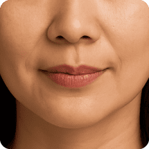 適合對象 法令紋 新願美學診所（郭毅昕醫師｜台北醫美推薦｜台北海芙音波媚必提｜海芙電波｜海菲秀｜探索皮秒｜喬雅登｜熊貓針推薦