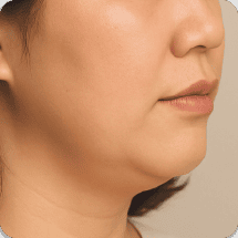 適合對象 輪廓模糊 新願美學診所（郭毅昕醫師｜台北醫美推薦｜台北海芙音波媚必提｜海芙電波｜海菲秀｜探索皮秒｜喬雅登｜熊貓針推薦）