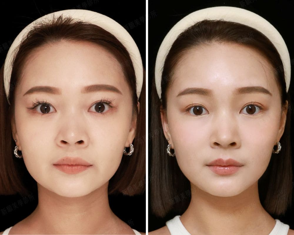 電波 新願美學診所（郭毅昕醫師｜台北醫美推薦｜台北海芙音波媚必提｜海芙電波｜海菲秀｜探索皮秒｜喬雅登｜熊貓針推薦）