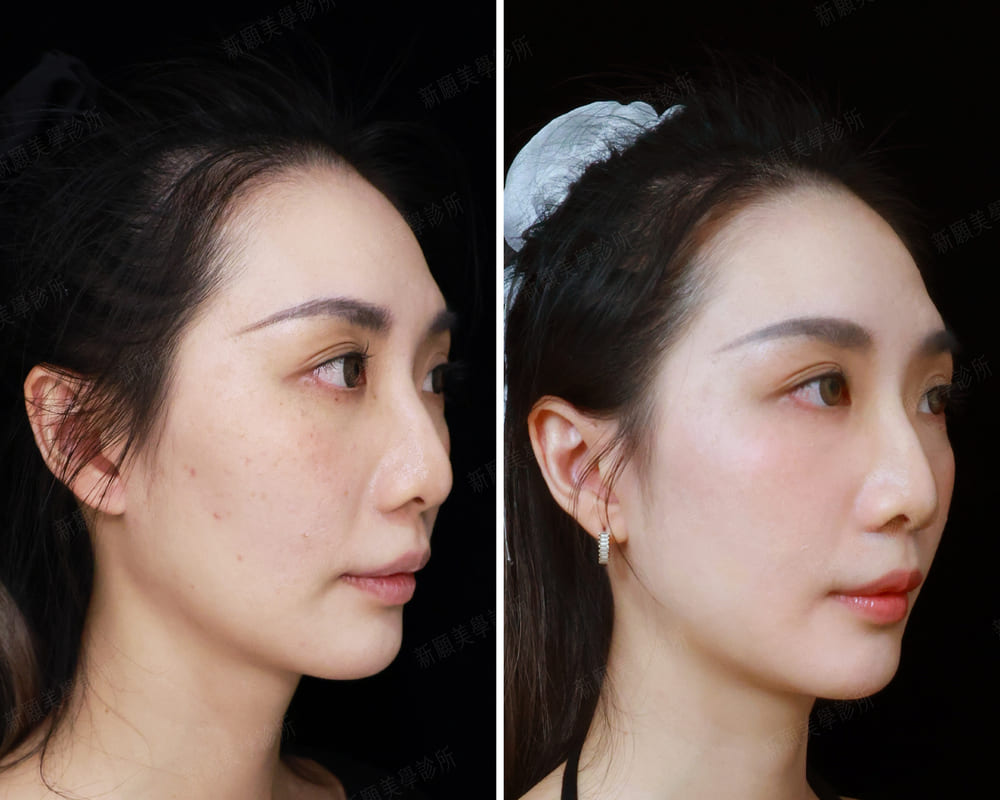 電波 新願美學診所（郭毅昕醫師｜台北醫美推薦｜台北海芙音波媚必提｜海芙電波｜海菲秀｜探索皮秒｜喬雅登｜熊貓針推薦）