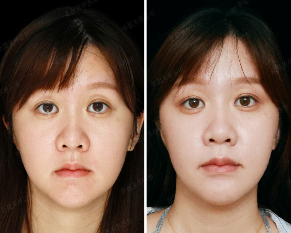 音波 新願美學診所（郭毅昕醫師｜台北醫美推薦｜台北海芙音波媚必提｜海芙電波｜海菲秀｜探索皮秒｜喬雅登｜熊貓針推薦）