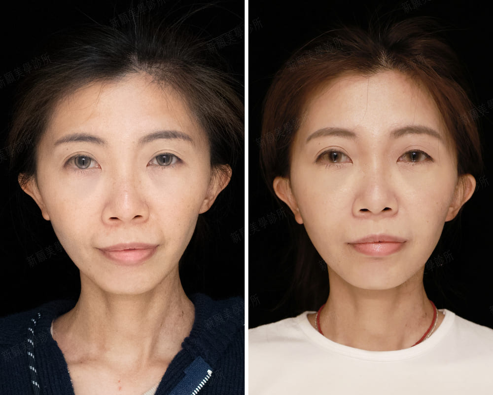 頰凹 新願美學診所（郭毅昕醫師｜台北醫美推薦｜台北海芙音波媚必提｜海芙電波｜海菲秀｜探索皮秒｜喬雅登｜熊貓針推薦）