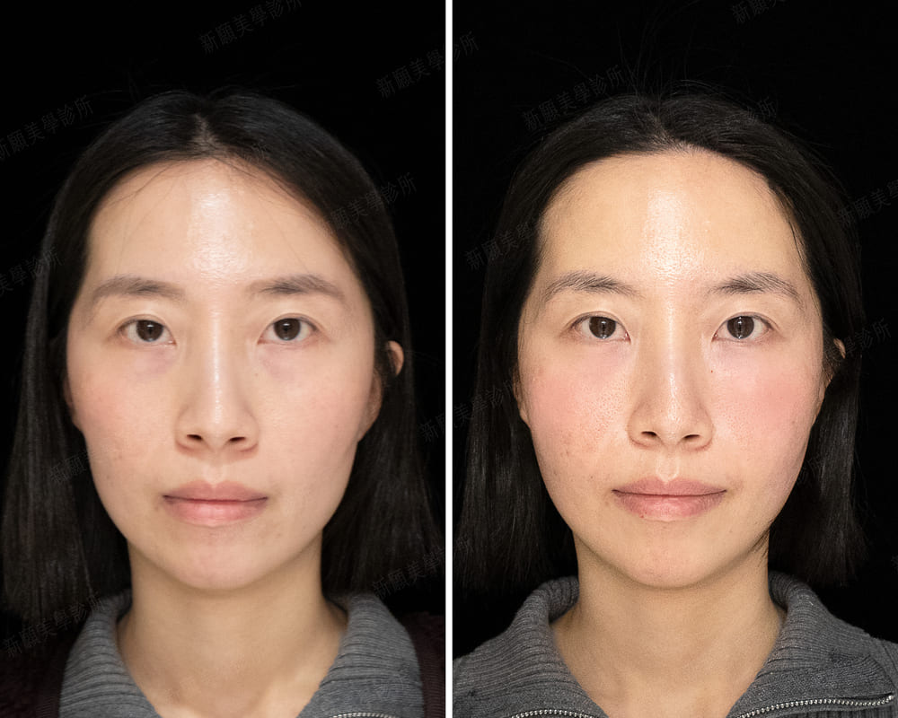 頰凹 新願美學診所（郭毅昕醫師｜台北醫美推薦｜台北海芙音波媚必提｜海芙電波｜海菲秀｜探索皮秒｜喬雅登｜熊貓針推薦）