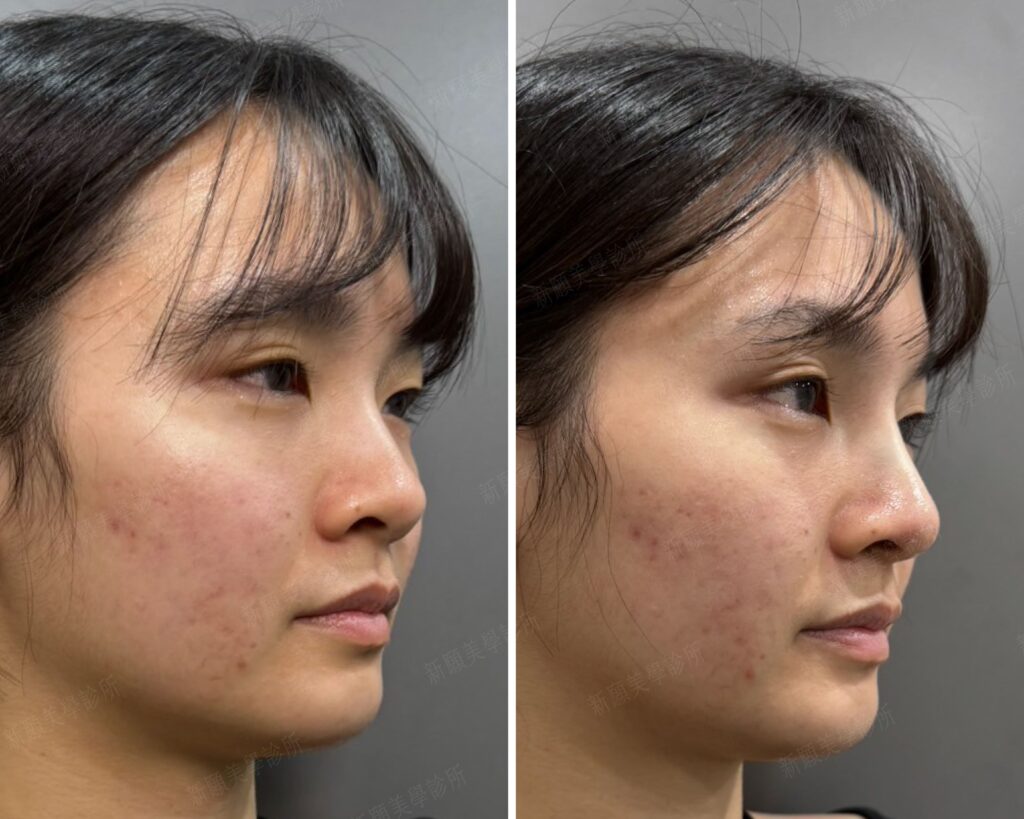 鼻雕 新願美學診所（郭毅昕醫師｜台北醫美推薦｜台北海芙音波媚必提｜海芙電波｜海菲秀｜探索皮秒｜喬雅登｜熊貓針推薦）