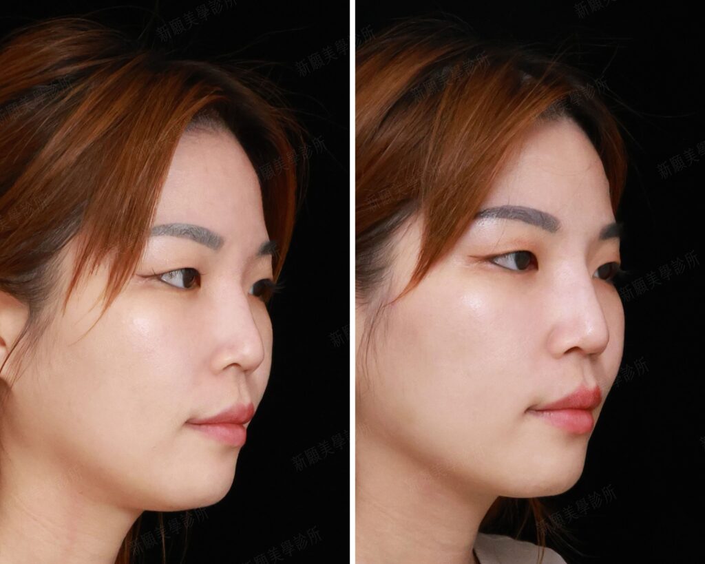 鼻雕 新願美學診所（郭毅昕醫師｜台北醫美推薦｜台北海芙音波媚必提｜海芙電波｜海菲秀｜探索皮秒｜喬雅登｜熊貓針推薦）