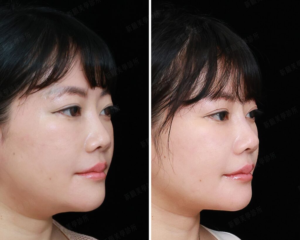 鼻雕 新願美學診所（郭毅昕醫師｜台北醫美推薦｜台北海芙音波媚必提｜海芙電波｜海菲秀｜探索皮秒｜喬雅登｜熊貓針推薦）