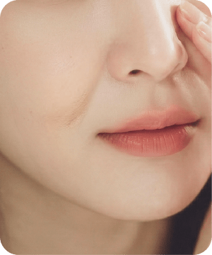 精選項目-法令紋 新願美學診所（郭毅昕醫師｜台北醫美推薦｜台北海芙音波媚必提｜海芙電波｜海菲秀｜探索皮秒｜喬雅登｜熊貓針推薦）