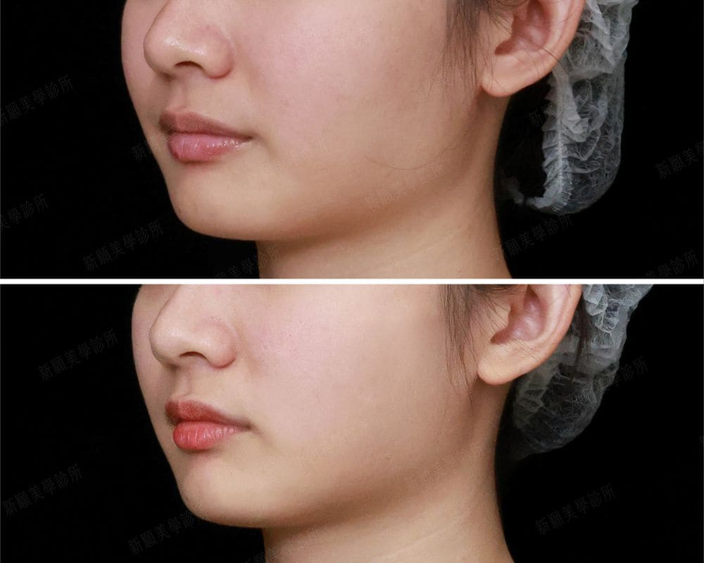 咀嚼肌 新願美學診所（郭毅昕醫師｜台北醫美推薦｜台北海芙音波媚必提｜海芙電波｜海菲秀｜探索皮秒｜喬雅登｜熊貓針推薦）