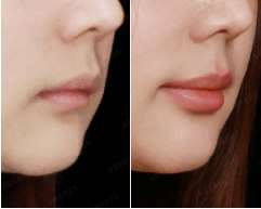 嘴唇案例-新願美學診所（郭毅昕醫師｜台北醫美推薦｜台北海芙音波媚必提｜海芙電波｜海菲秀｜探索皮秒｜喬雅登｜熊貓針推薦）