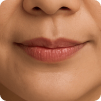 困擾-唇紋深-新願美學診所（郭毅昕醫師｜台北醫美推薦｜台北海芙音波媚必提｜海芙電波｜海菲秀｜探索皮秒｜喬雅登｜熊貓針推薦）