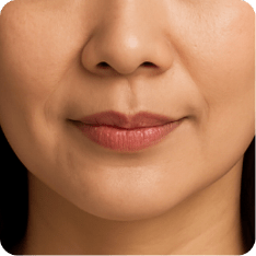 困擾-法令紋深-新願美學診所(郭毅昕醫師|台北醫美推薦|台北海芙音波媚必提|海芙電波|海菲秀|探索皮秒|喬雅登|熊貓針推薦)