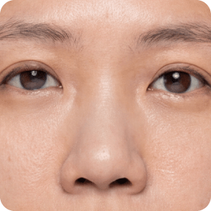 鼻雕 困擾-鼻子短小