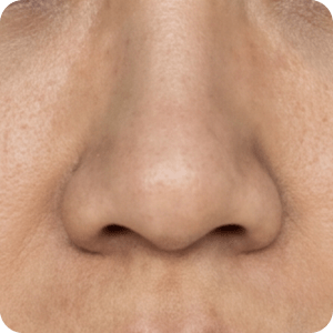 鼻雕 困擾-鼻頭圓潤