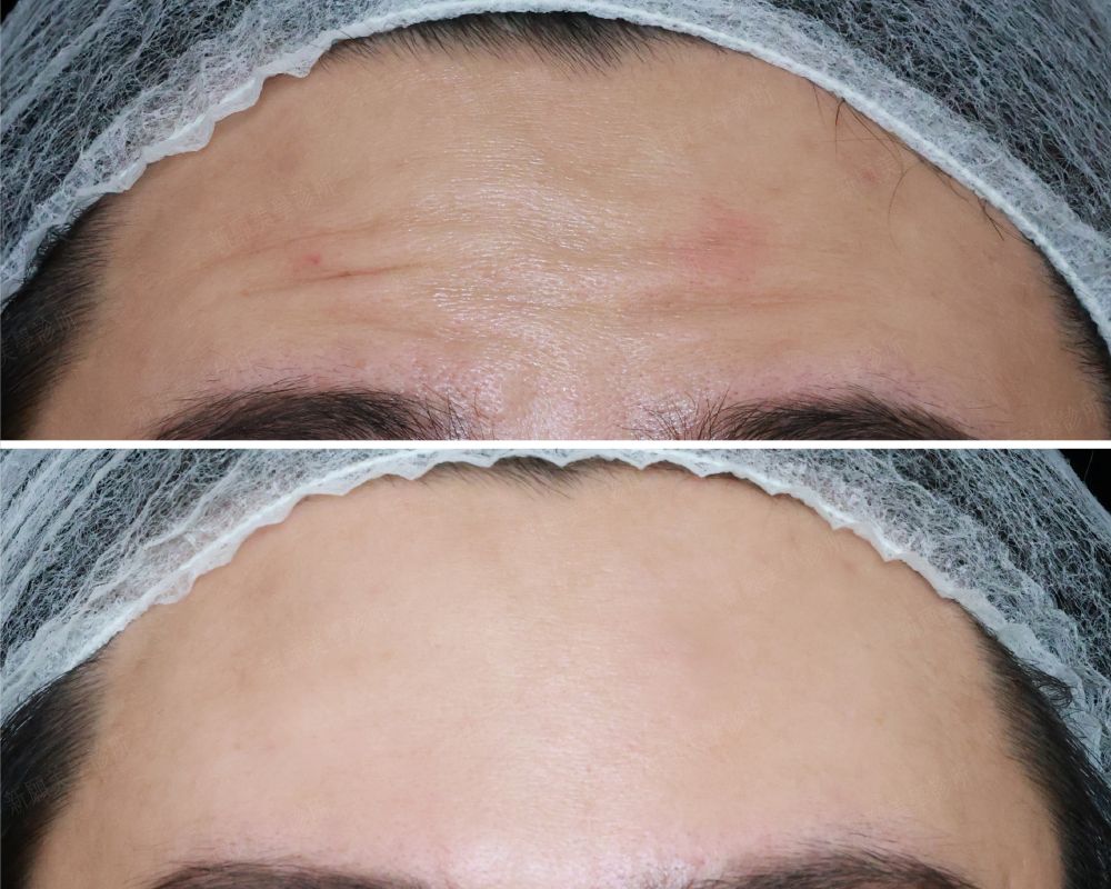 除皺抬頭紋 新願美學診所（郭毅昕醫師｜台北醫美推薦｜台北海芙音波媚必提｜海芙電波｜海菲秀｜探索皮秒｜喬雅登｜熊貓針推薦）