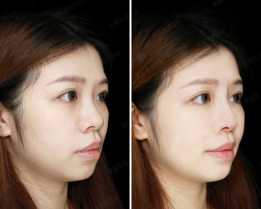 鼻雕案例 新願美學診所（郭毅昕醫師｜台北醫美推薦｜台北海芙音波媚必提｜海芙電波｜海菲秀｜探索皮秒｜喬雅登｜熊貓針推薦