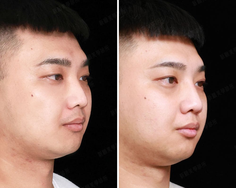 鼻雕案例 新願美學診所（郭毅昕醫師｜台北醫美推薦｜台北海芙音波媚必提｜海芙電波｜海菲秀｜探索皮秒｜喬雅登｜熊貓針推薦）